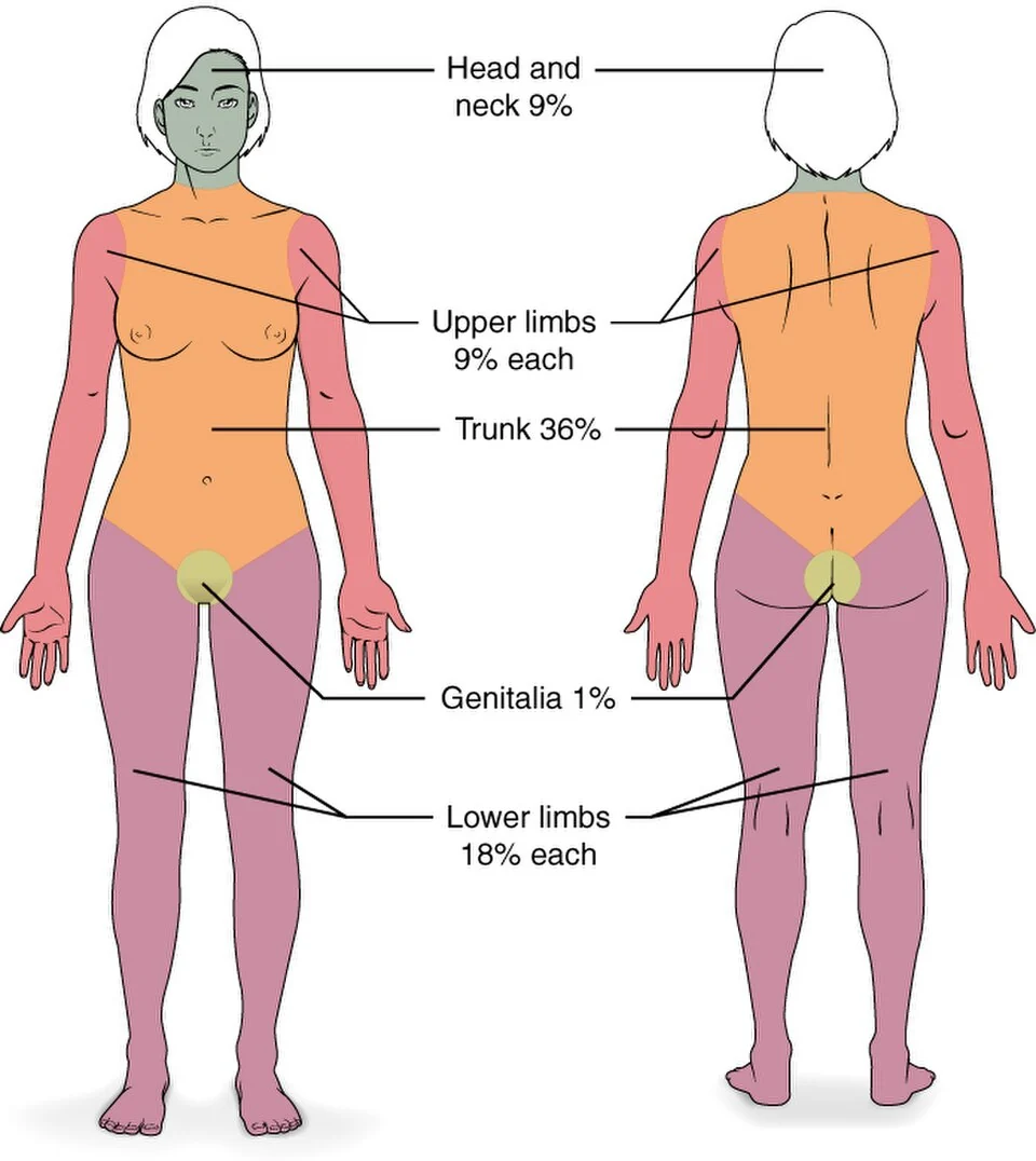 The rule of nines estimates the percentage of body surface burned (adults).