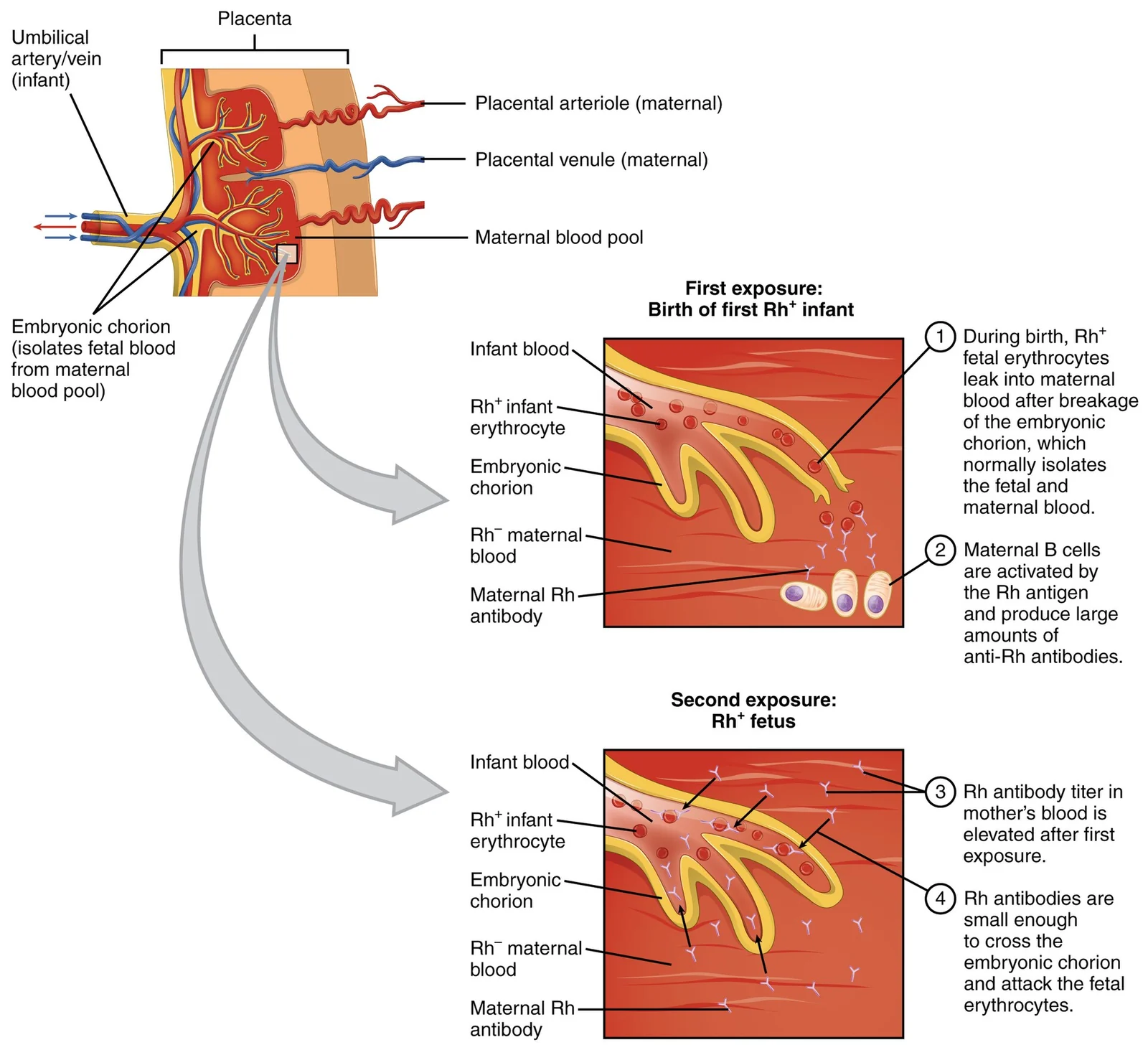 Hemolytic disease of the newborn (erythroblastosis fetalis).