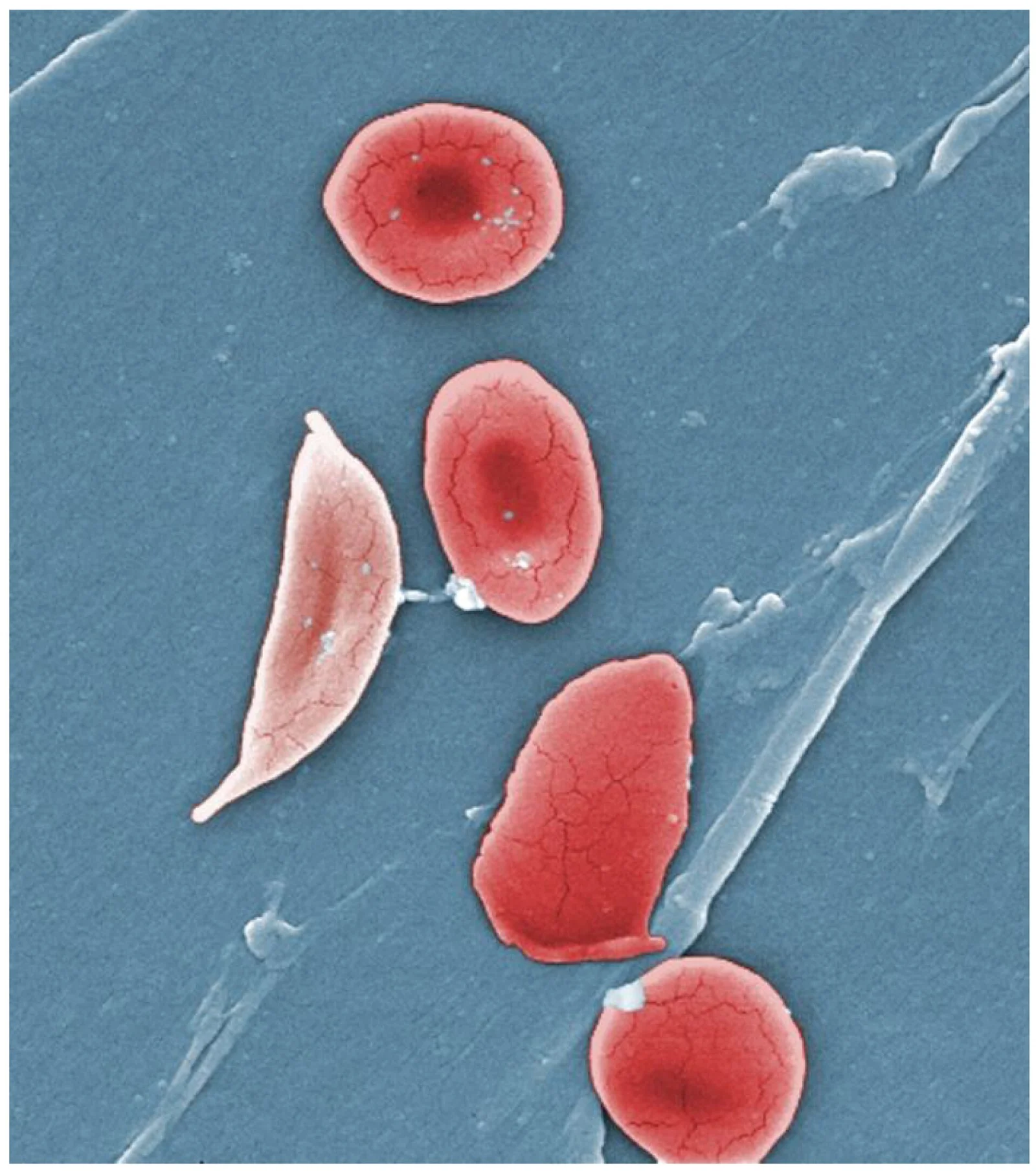 Sickle cells.