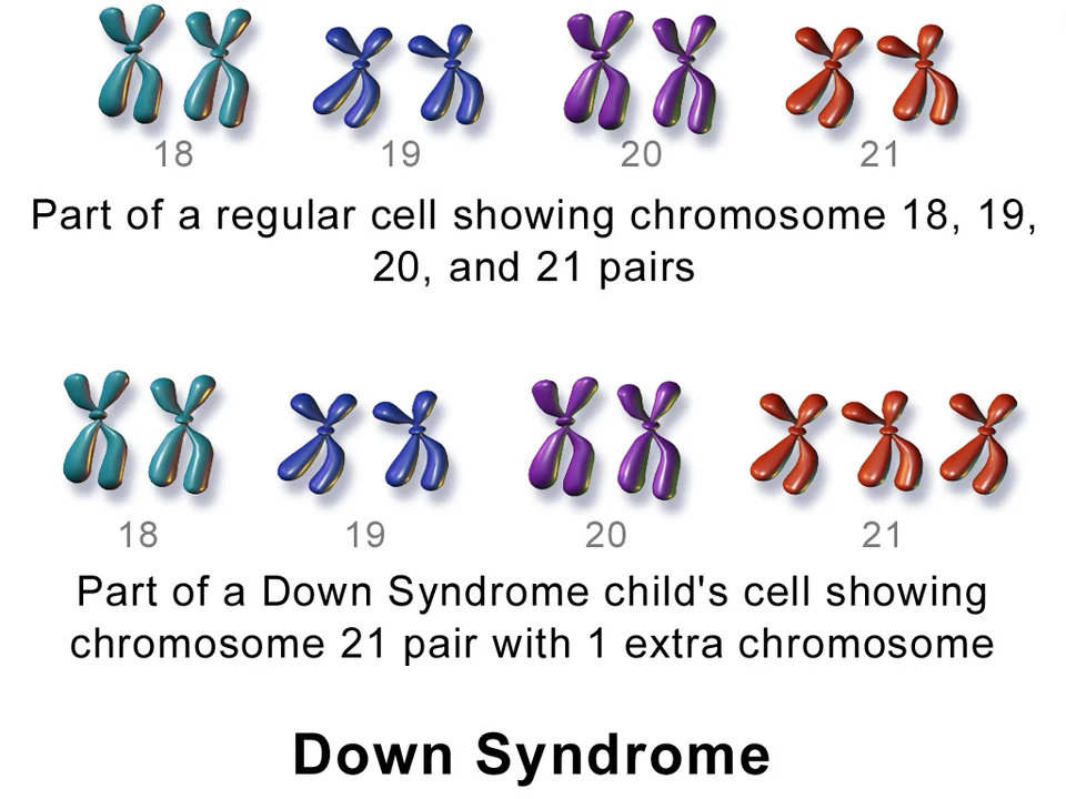 Down syndrome (trisomy 21).